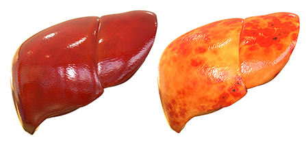 liver disease faq